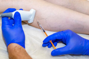 varicose veins