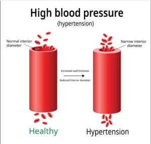 Hypertension