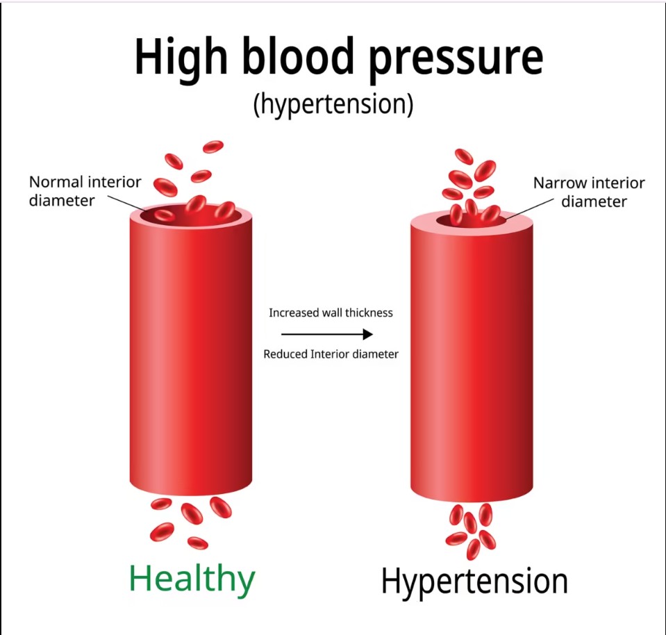 Hypertension